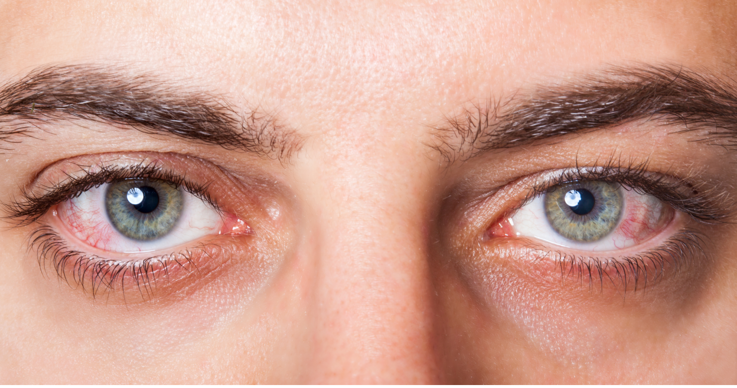 Why Are My Eyes Red?