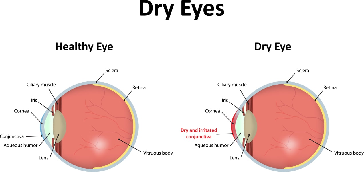 symptoms of dry eye