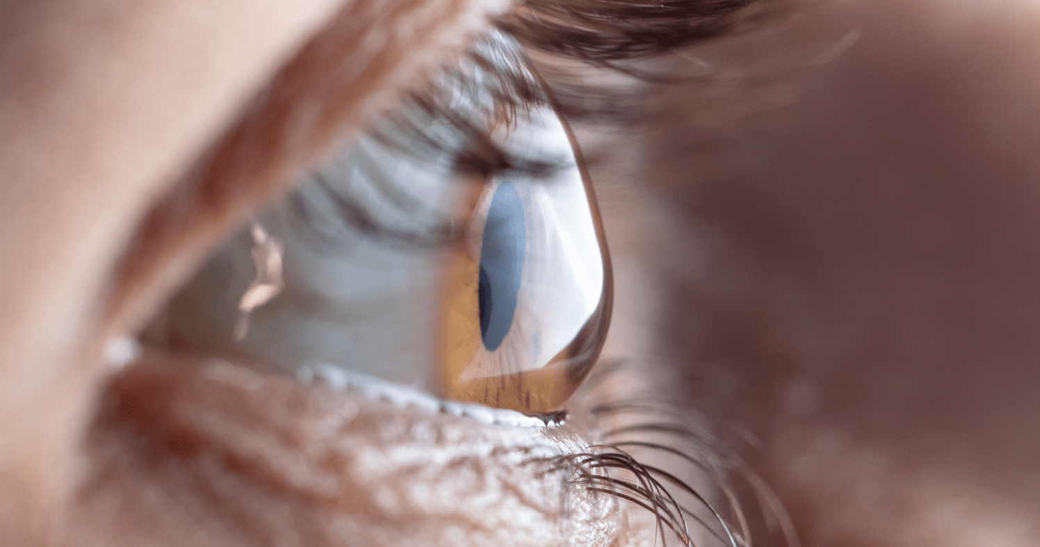 lazy eye in adults
