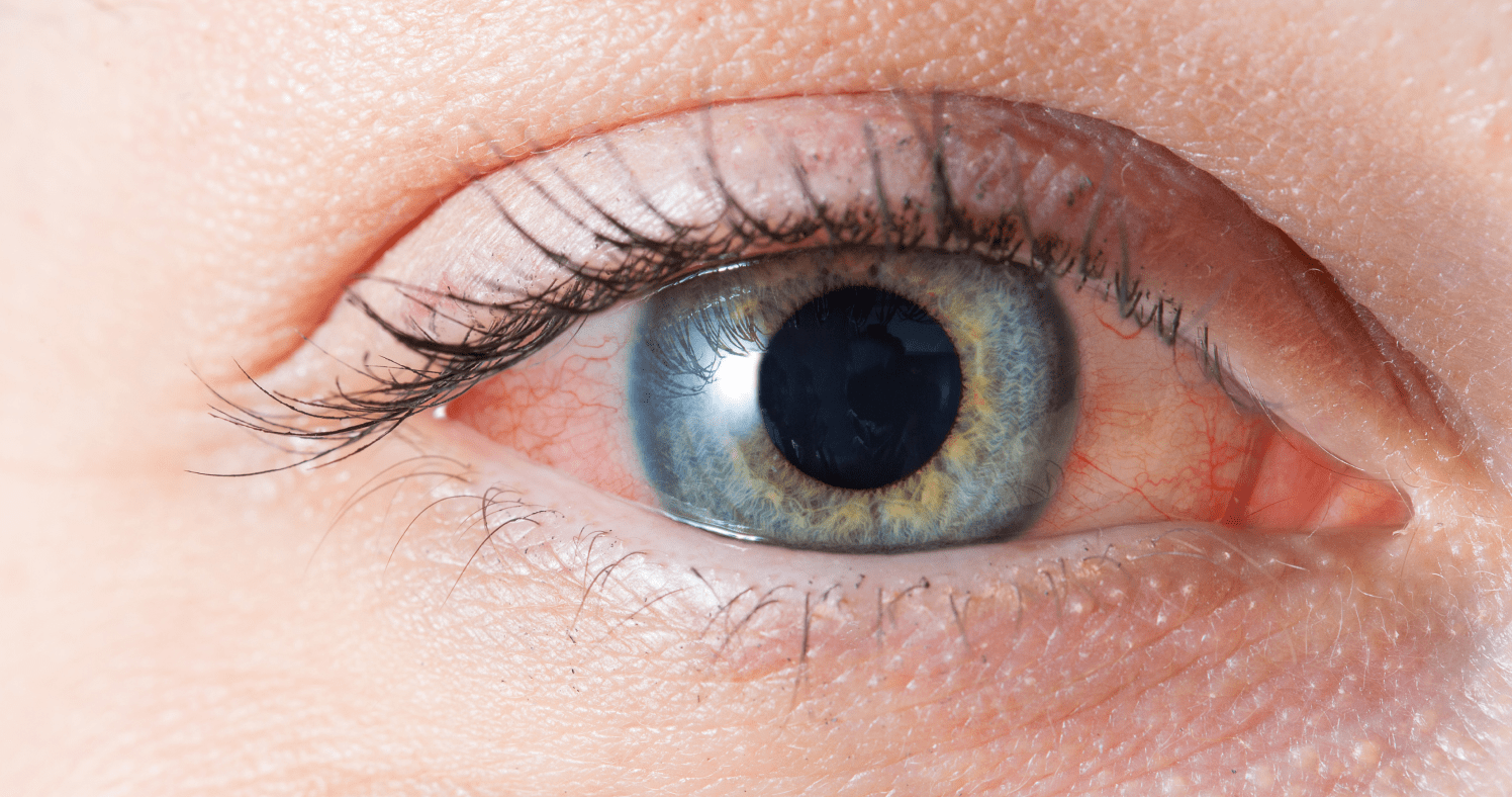 How to fix red eyes