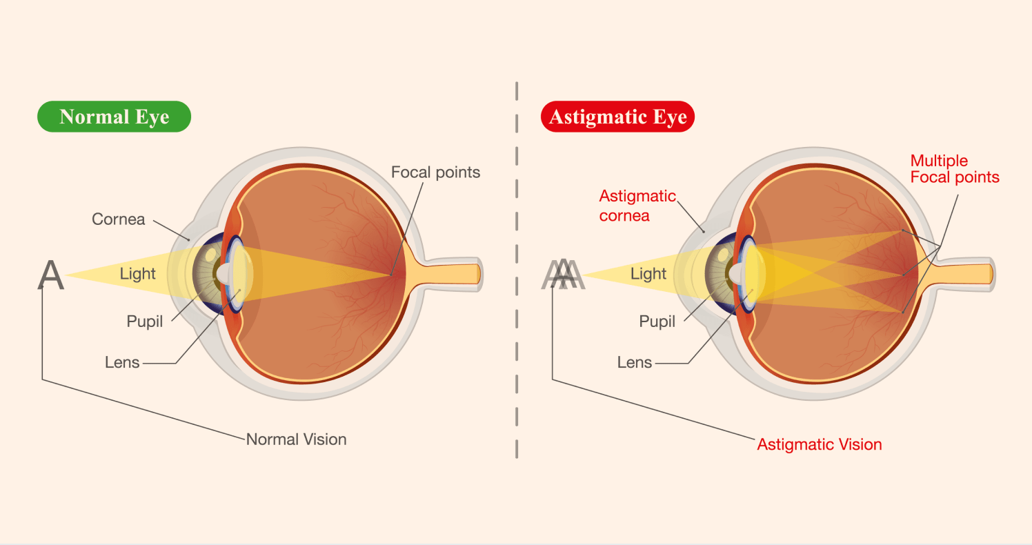 what does astigmatism look like