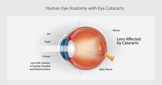 What do cataracts look like