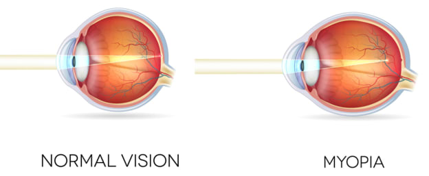 what does myopia look like