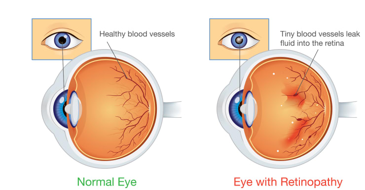 diabetic retinopathy eye images